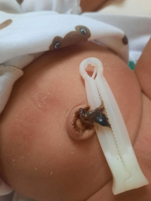 Pusar bayi 7hr belum copot