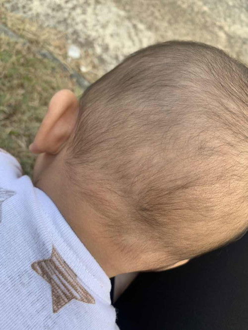 Ketombe putih dikepala bayi