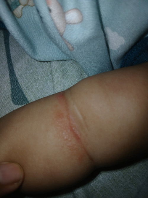 Bu ibu ada yang tau ga ini kenapa ya dilipetan tangan anak ku kaya gini