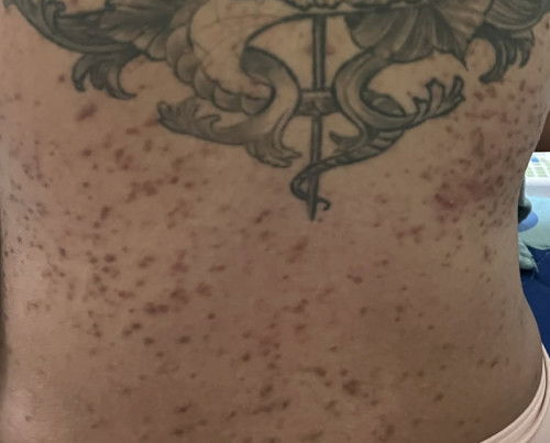 สิวฮอร์โมนหรือผื่นอะไรคะ