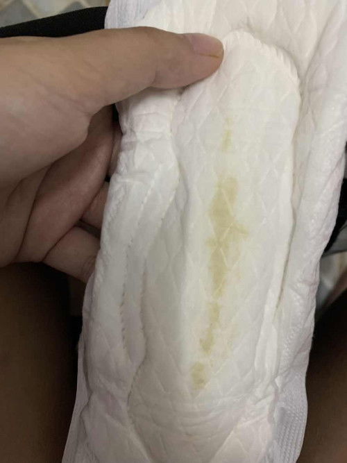 ตกขาวในคนท้อง