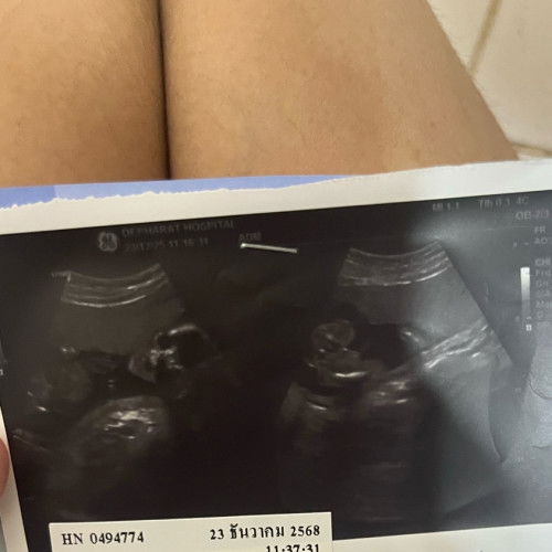 สอบถามหน่อยค่ะแม่ๆ ภาพนี้น้องนอนท่าไหนยังไงคะ  ดูไม่ออกเลยค่ะ ท้อง5เดือนค่ะเพศชาย น้องนอนปกติมั้ยคะทำไมมันดูแปลกๆ🥲🙏🏻