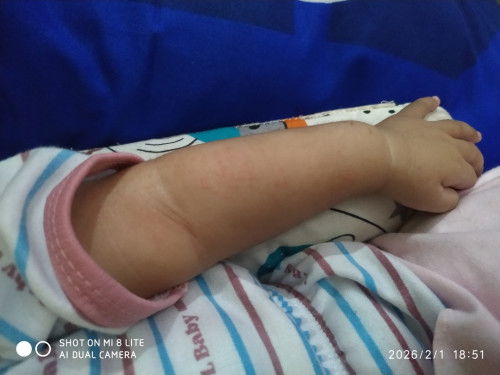 Cara atasi biang keringat pada bayi