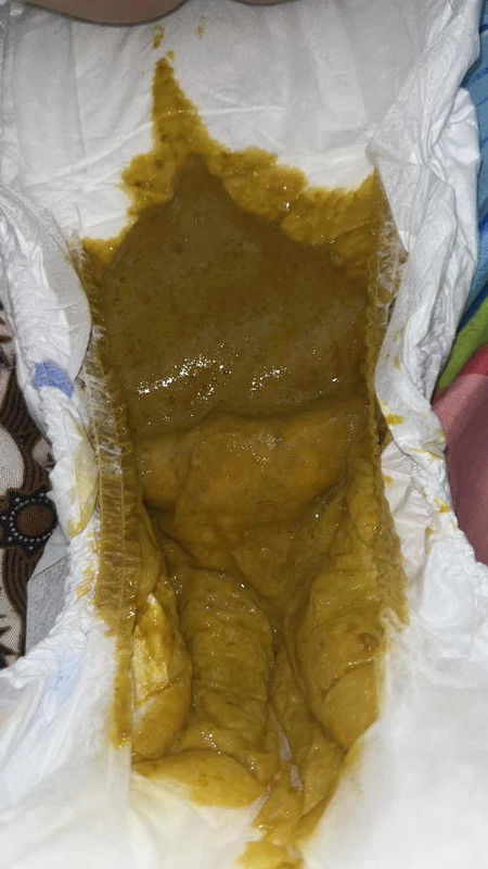 Tekstur poop tidak seperti biasa