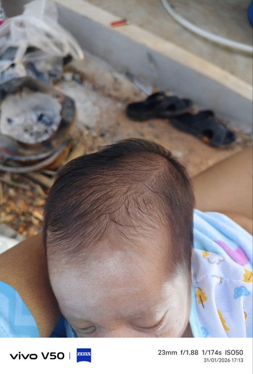 ขอสอบถามหน่อยค่ะน้องได้19วัน
หัวบวมหัวโนตั้งแต่ตอนคลอดนานไหมค่ะมันจะยุบความรู้สึกแม่เหมือนมันไม่ยุบ