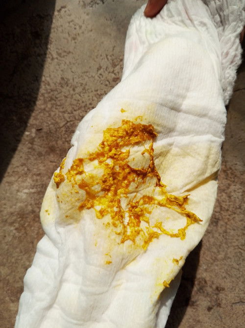 อุจจาระเป็นแบบนี้ปกติม้้ยค่ะ