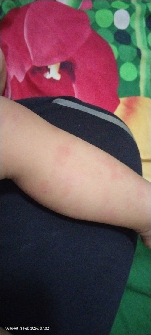 Tiba² bentol merah² tpi gatel