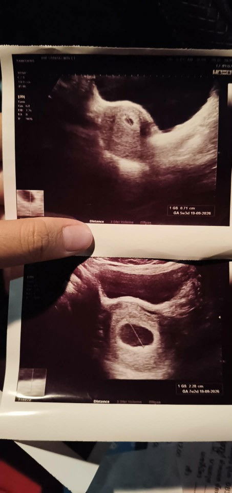 การเจอตัวอ่อน