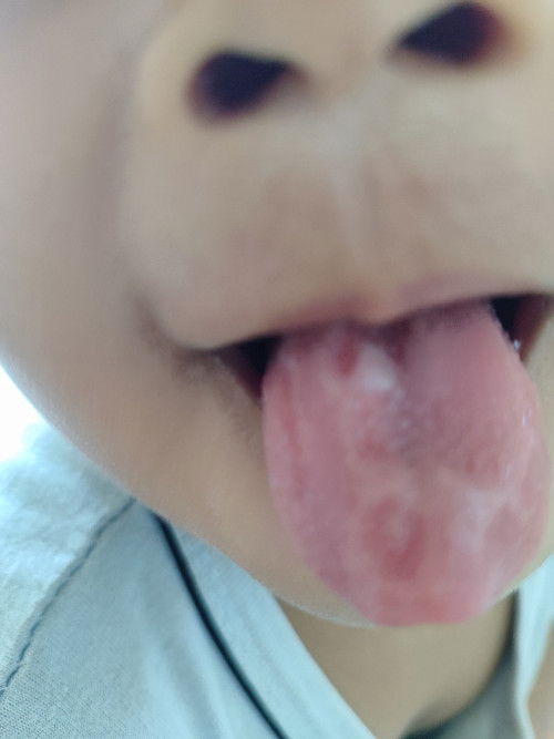 Kondisi lidah anak saya kok gini yaa, apa panas dalam ya?