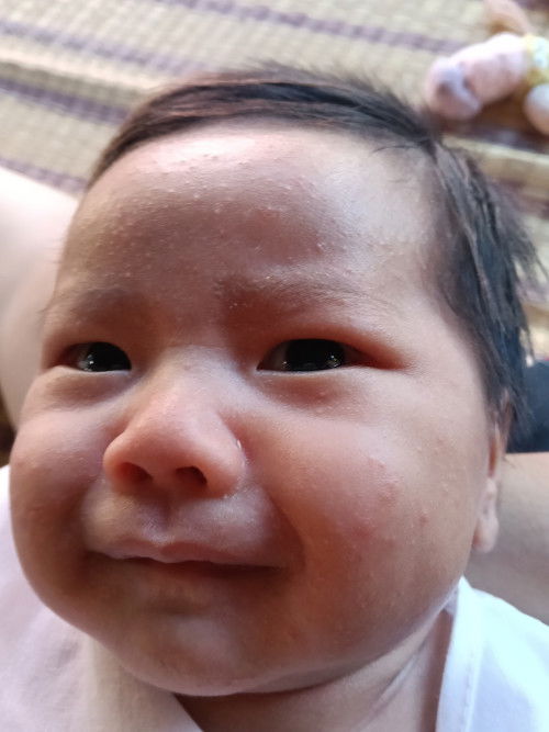 ขอสอบถามหน่อยค่ะ พอดีลูกมีตุ่มผดแบบนี้เกิดจากอะไรคะ