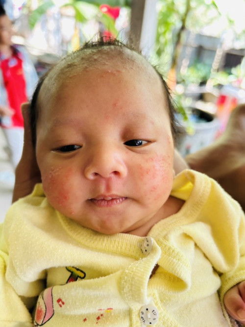 เเม่ๆคะผื่นเเบบนี้เกิดขึ้นจากอะไรคะ