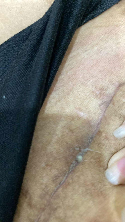 แผลผ่าคลอด1เดือน นอนอยู่เฉยๆรู้สึกคันๆมีหนองไหลออกมาแบบนี้ แสดงว่าแผลปริ ติดเชื้อใช่มั้ยคะ