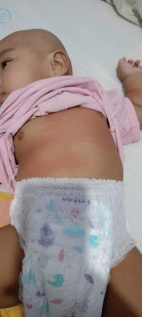 Merah merah di perut bayi