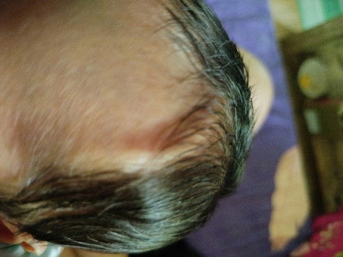 Bun ada yg sama GK bayi 15hari kepalanya ada benjol garis gitu kaya bondu gitu