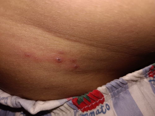 อยากจะถามว่าผื่นขึ้นแบบนี้เกิดจากอะไรค่ะปกติมั้ย