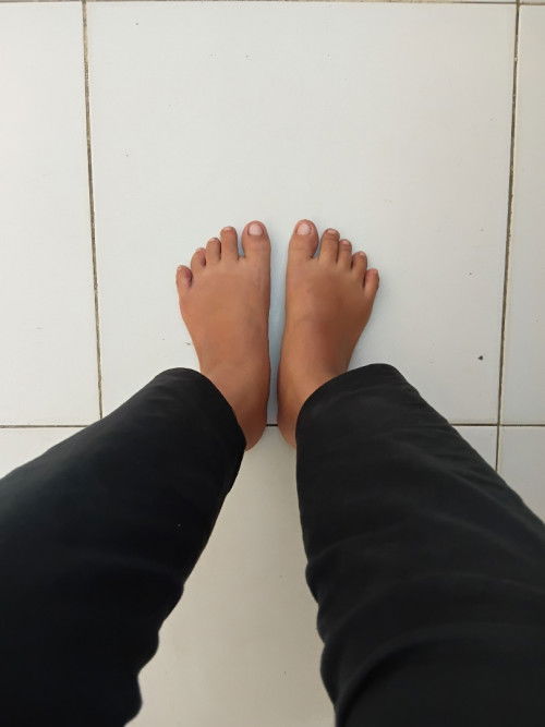 permisi kakak kakak mau tanya kalau kaki seperti ini apakah termasuk kategori bengkak?