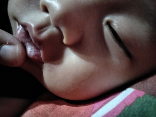 Bintik putih di bibir bayi