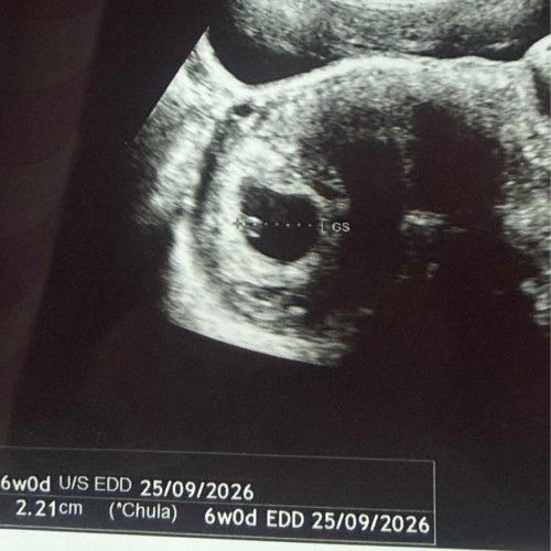 ถุงการตั้งครรภ์ 2.1 cm ตอน 6 Week แต่ยังไม่เจอตัวอ่อน