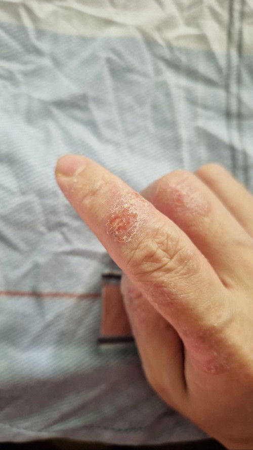 Dyshidrotic Eczema
