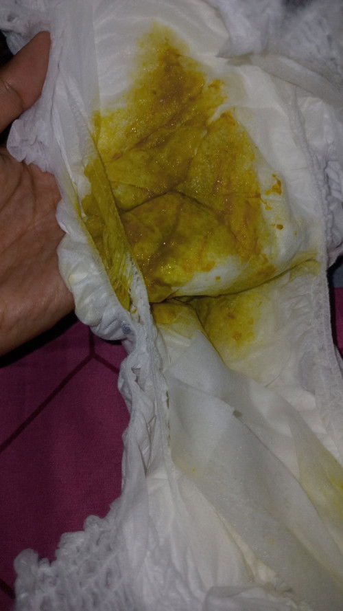 Diare bayi umur 11 bulan