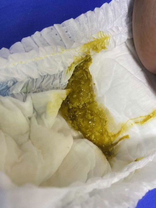 อึลูก 4เดือน5วัน