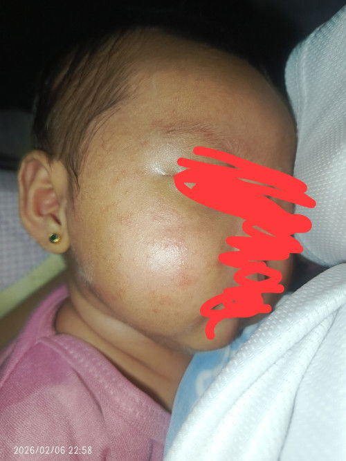 Baby Acne/Rashes