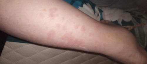 Ruam merah gatal dan nimbul