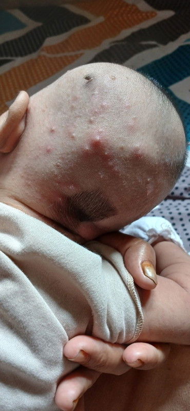 Bintik merah, biduran pada bayi