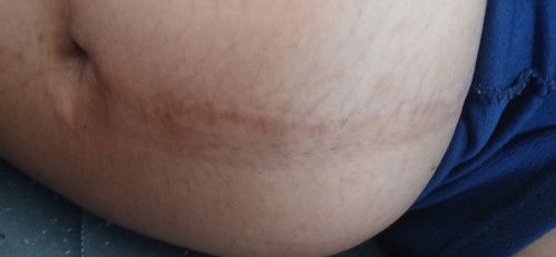 37+2วีคเจ็บแผลผ่าคลอดเก่า