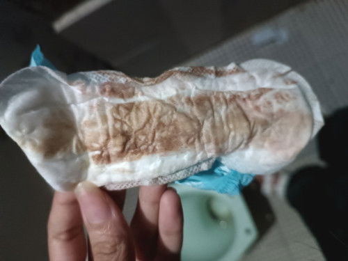 Dinugo kahit positive sa pt 1month