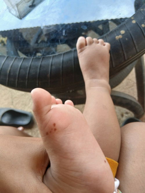 Bund ada yg tau ga ini kenapa tiba2 muncul bintik merah gelap gini