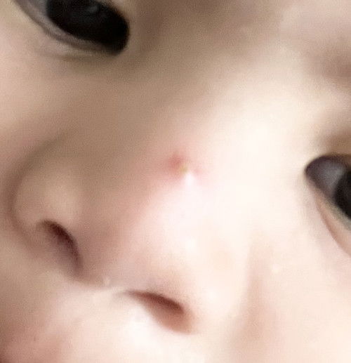 Pigsa sa nose ng 1 year old ko.