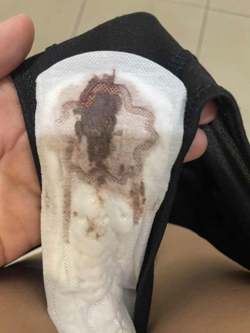 ตกขาวสีน่ำตาล