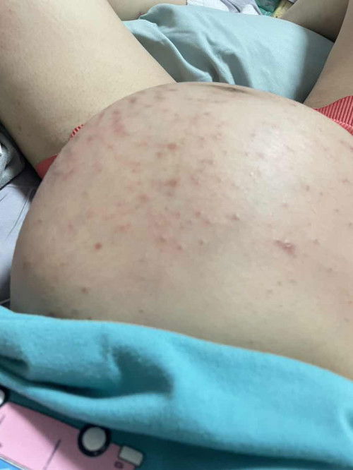 Skin rashes at 37 weeks