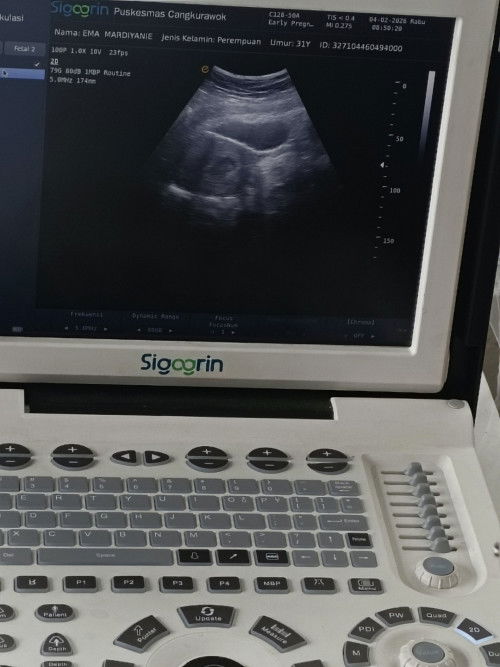 kantung kehamilan kecil