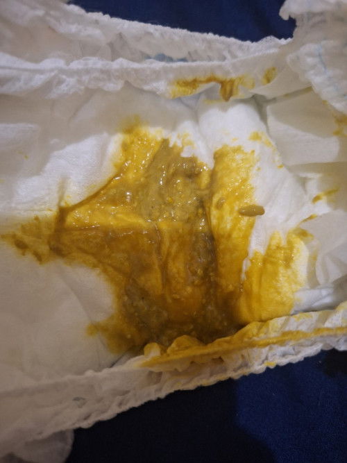 Bun mau tanya anak saya pup nya seperti ini dan bahkan bab nya lebih dari 3 kali apakah tidak cocok