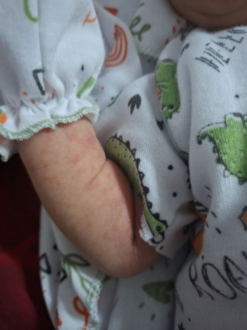 Ruam atau biang keringat atau apa yaa?