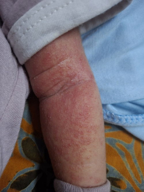 Biang keringat atau apa yaa?