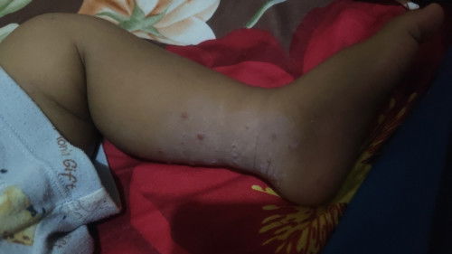 Apakah ini cacar air??