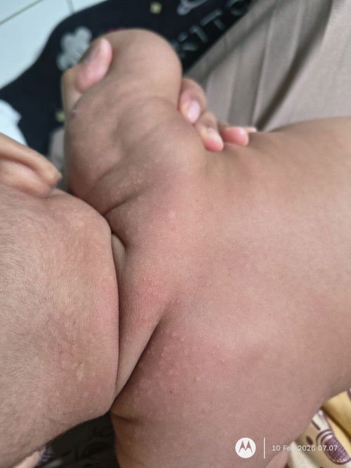 Bercak putih di bayi