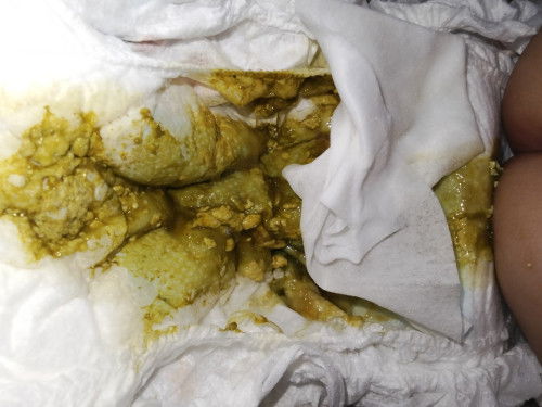 Berak kerap lebih 3x