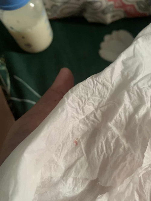 Bayi 4 bulan pipis sambil mengejan (urine disertai bercak darah sedikit) dan berbau amis.