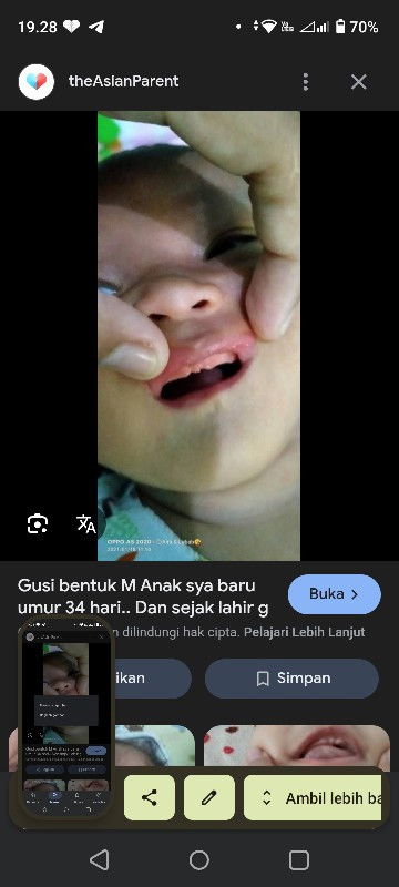 Gusi bayi berbentuk M