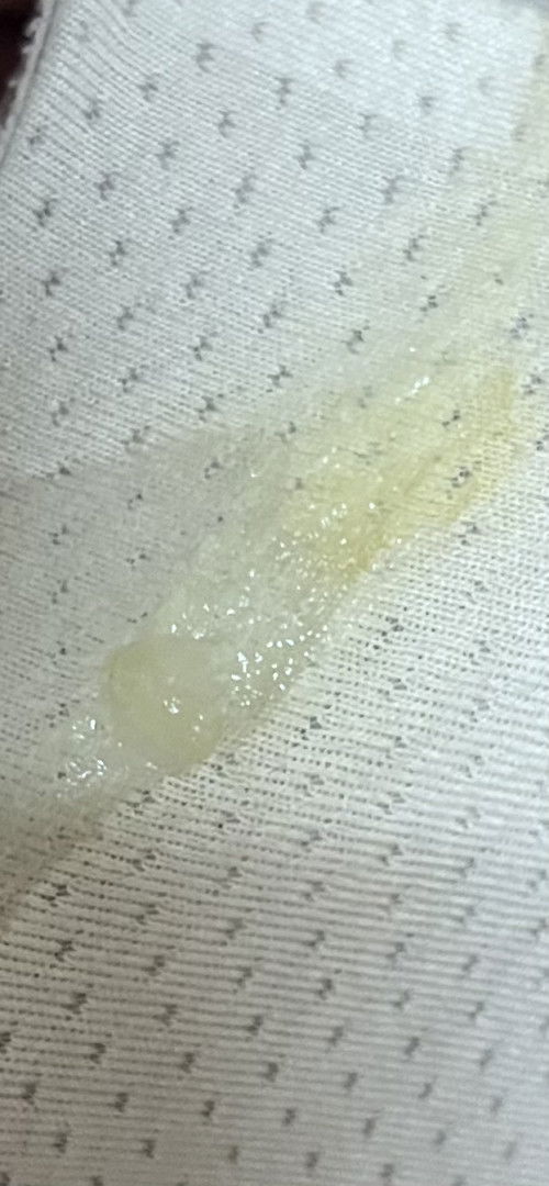 มูกใสหรือตกขาว