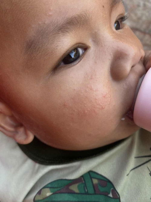 ผื่นเกิดจากอะไรคะน้อง7เดือนค่ะ