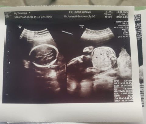 Halo sya mau tanya dlu ni
Apakah anak bisa kepala kebawa atau tidak ya
Soalnya dia pantad di bawa ni