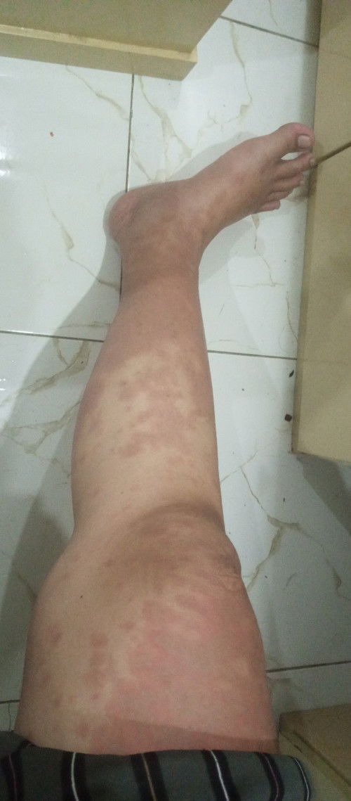 Ada yg pernah ngalami puppp di kehamilan tm3 Bun?