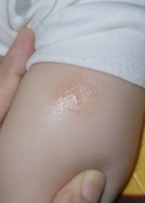 Ruam merah pada kaki bayi