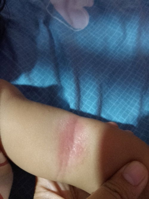 Baby Eczema.