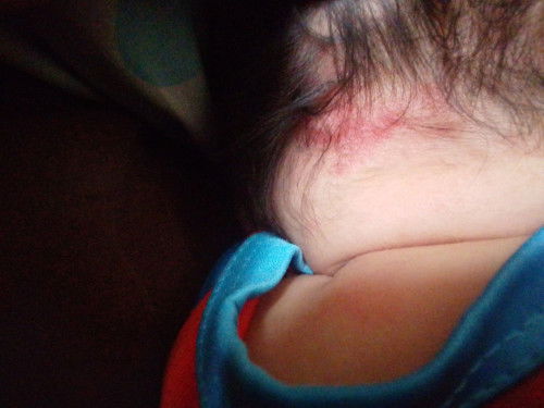 Normal lng po ba Yung pula sa batok Ng baby ko